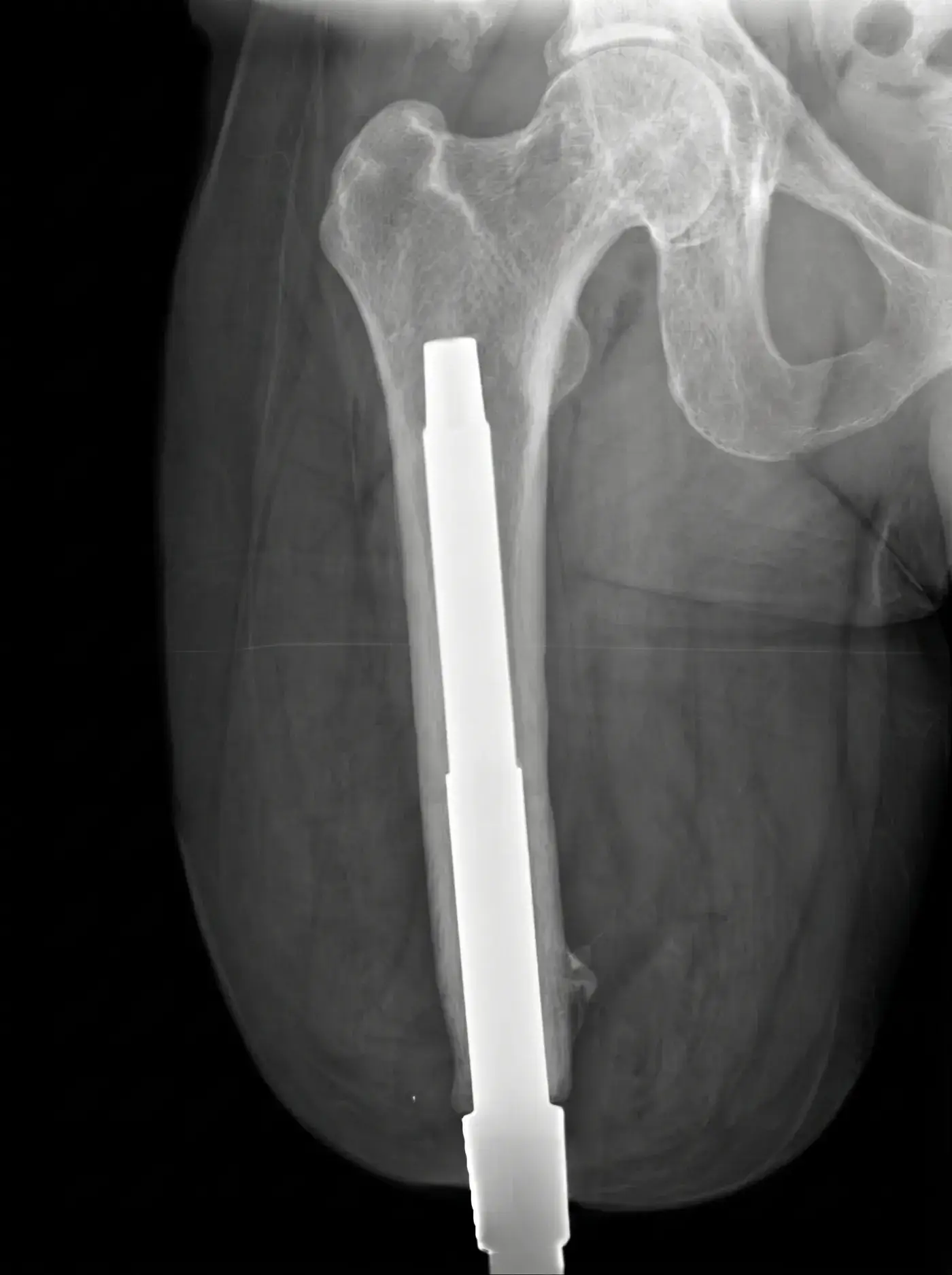 Radiograph of a transfemoral osseointegrated implant anchored in the femur